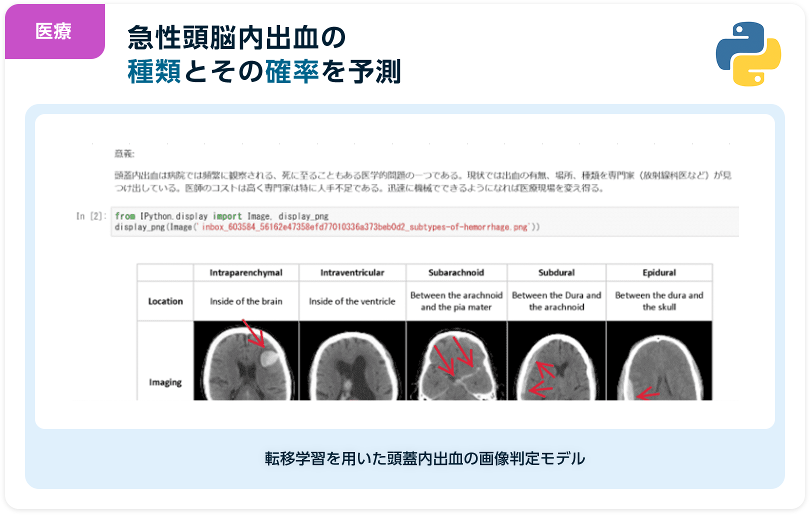 医療 急性頭脳内出血の種類とその確率を予測